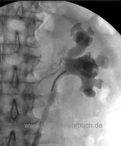 retrograde Pyelographie lymphatischer Reflux