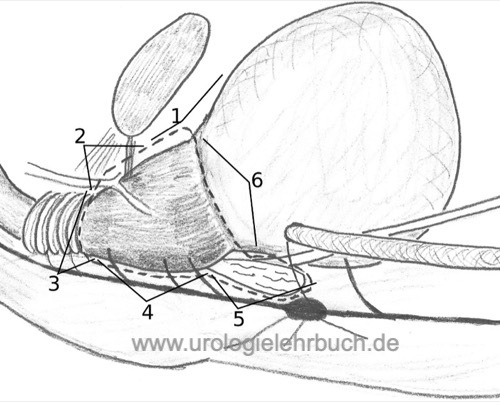 Abbildung Schematische Darstellung der einzelnen Operationsschritte der retropubischen radikalen Prostatektomie