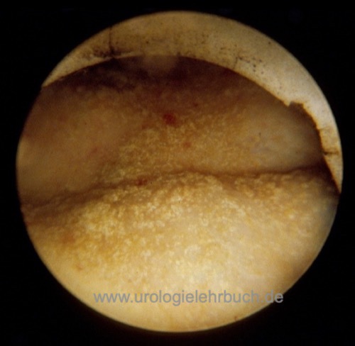 Abbildung Zystoskopie mit sandy patches bei Schistosomiasismanifestation Bilharziose in der Harnblase