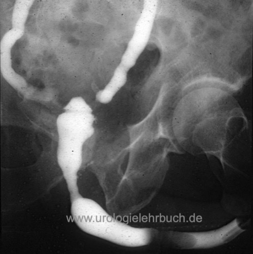 Abbildung tuberkulöse Schrumpfblase mit Ureterstrikturen