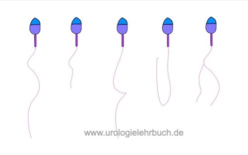 Abbildung normales Hauptstück (Schwanz) der Spermatozoen und mögliche Hauptstückdefekte bei Teratozoospermie.