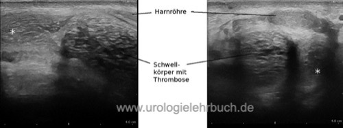 Perineale Sonographie einer rechtsseitigen partiellen Schwellkörperthrombose