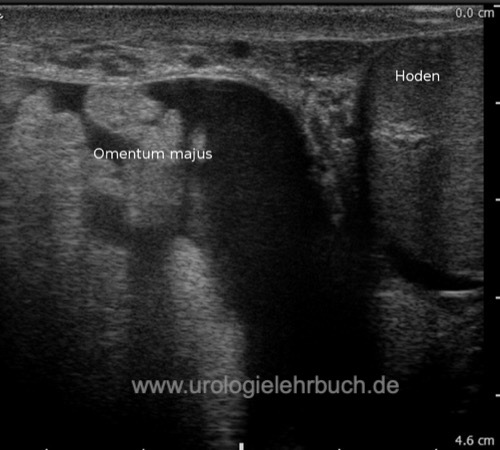 Abbildung Sonographie des Skrotums bei einer Skrotalhernie