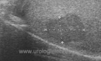 Sonographie eines Hodentumors