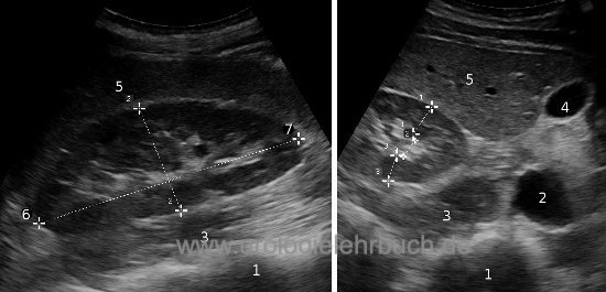 Abbildung Ultraschall-Anatomie und Sonographie Normalbefund der Nieren