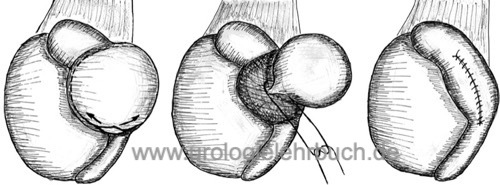 Abbildung Spermatozelenresektion