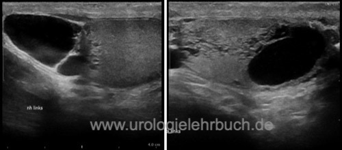 Abbildung Sonographie Skrotum: Spermatozele mit tubulärer Ektasie des Rete testis