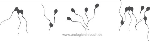 Abbildung Agglutination von Spermatozoen im Ejakulat.