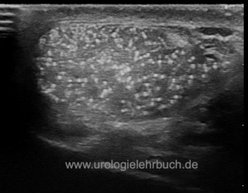 Abbildung Sternenhimmel testikuläre Mikrolithiasis