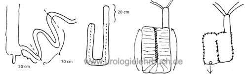 Ileum Neoblase nach Studer Harnableitung nach Zystektomie Harnblasenkarzinom