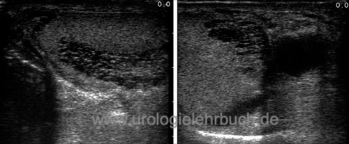 Abbildung tubuläre Ektasie des Rete testis (TERT) mit Spermatozele