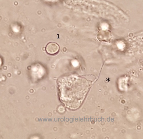 Abbildung Trichomonade im Urinsediment