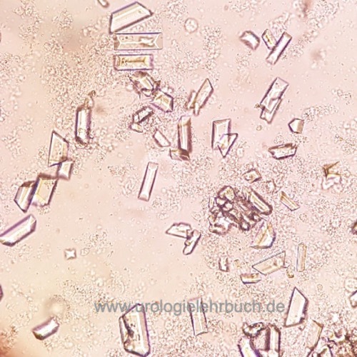 Abbildung Tripelphosphat-Kristalle im Urinsediment