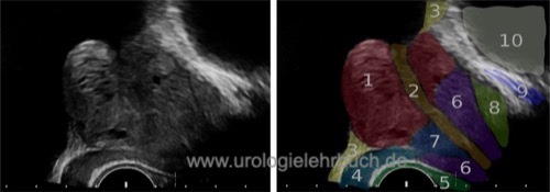 TRUS transrektale Ultraschall Sonographie Untersuchung der Prostata sagittal