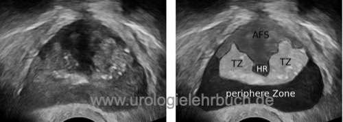 TRUS transrektale Ultraschall anteriores fibromuskuläres Stroma (AFS), periphere Zone, Übergangszone (TZ) und Harnröhre (HR)