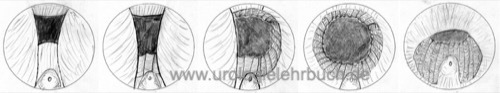 Abbildung Transurethrale Resektion der Prostata (TURP)