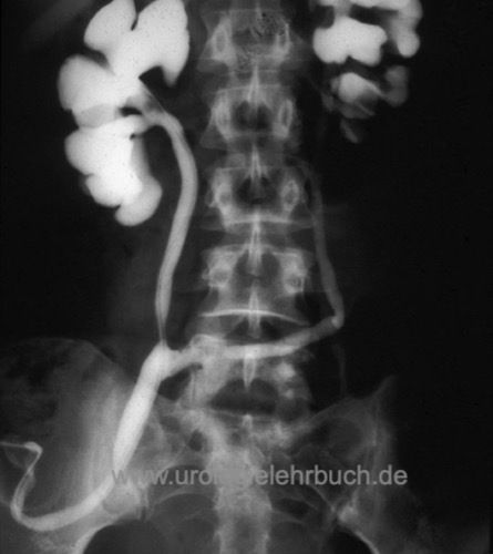 Abbildung Ureterocutaneostomie: retrograde Pyelographie einer Trans-uretero-uretero-cutaneostomie