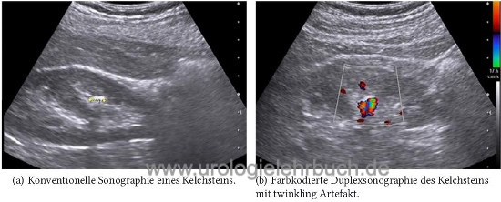 Abbildung twinkling Artefakt bei Nephrolithiasis