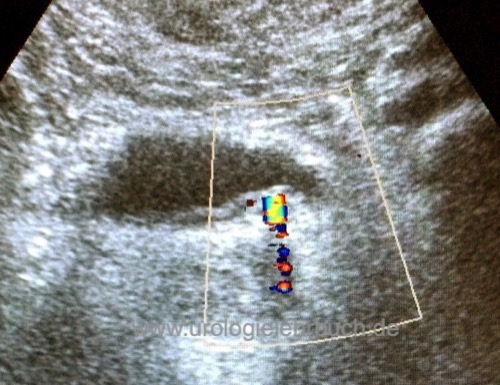 Sonographie prävesikaler Harnleiterstein mit twinkling artefakt