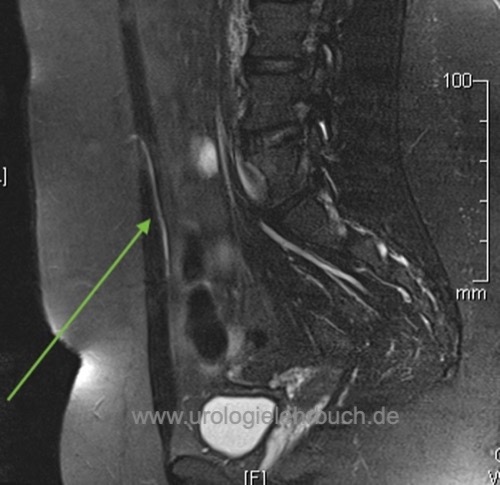 Abbildung MRT einer Urachusfistel