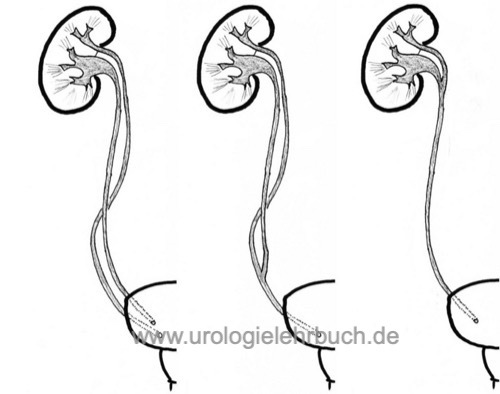 Ausprägungen der Ureterduplikatur: doppelter Harnleiter, Doppelniere, Ureter duplex und Ureter fissus