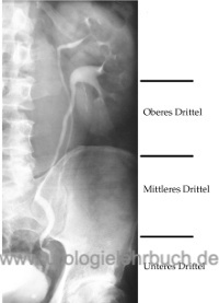 Abb. radiologische Einteilung des Ureters (Harnleiter)