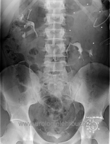 Abbildung Ureter duplex mit dropping lily sign (funktionsloses Oberpolsystem)