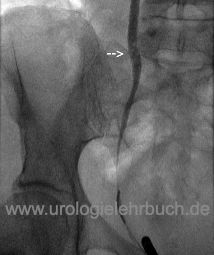 Abbildung Ureteritis cystica in der retrograden Pyelographie