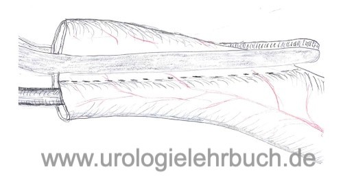 Abbildung Harnleiterpräparation vor Ureterzystoneostomie: Reduktion des Lumens durch Ureterwandresektion: Auf die Ureterdurchblutung muss geachtet werden.