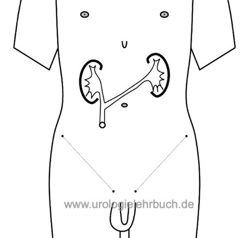 ureterocutaneostomie: Schemazeichung einer Harnleiter-Haut-Fistel