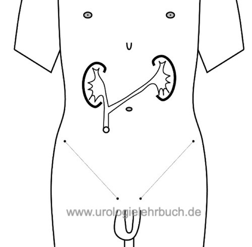 ureterocutaneostomie: Schemazeichung einer Harnleiterhautfistel