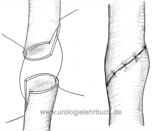 Abbildung Ureteroureterostomie Harnleiter End-zu-End Anastomose