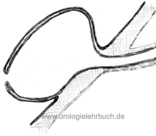 Ureterozele Symptome, Diagnose und Therapie