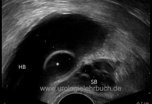 Abbildung Transrektale Sonographie einer Ureterozele