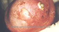 eitrige Urethritis eitrige Urethritis