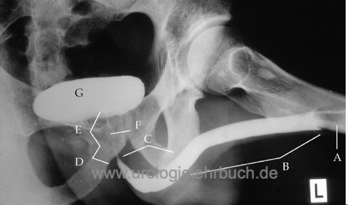 retrograde Urethrographie Harnröhre Röntgen