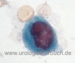 Abbildung pathologische Urinzytologie