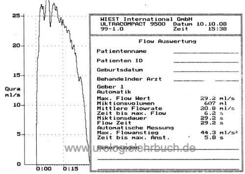 Normalbefund einer Harnstrahlmessung (Uroflow)