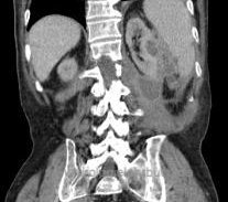 CT Nierenabszess als Ursache einer Sepsis