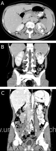 Urogenitaltuberkulose im CT-Abdomen: A+B) Manifestation an der linken Niere mit hypoperfundiertem Gewebe um die Oberpolkelche. C) Manifestation an der Harnblase mit narbiger Schrumpfung und linksseitiger Hydronephrose.