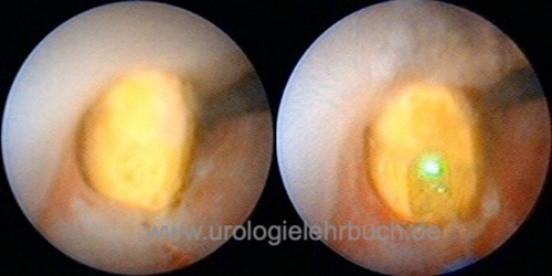 Abbildung Ureterorenoskopie: Desintegration eines Harnleitersteins mit einem Holmiumlaser.