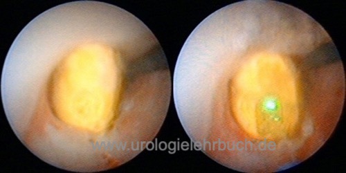 Abbildung Desintegration eines Harnleitersteins mit einem Holmiumlaser.