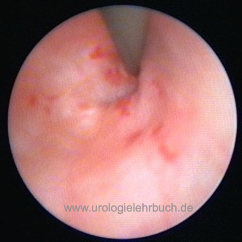 Abbildung Befunde der Ureterorenoskopie: Ureterkinking