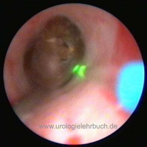 Abbildung Befunde der Ureterorenoskopie: Ureterstein vor Laserlithotripsie