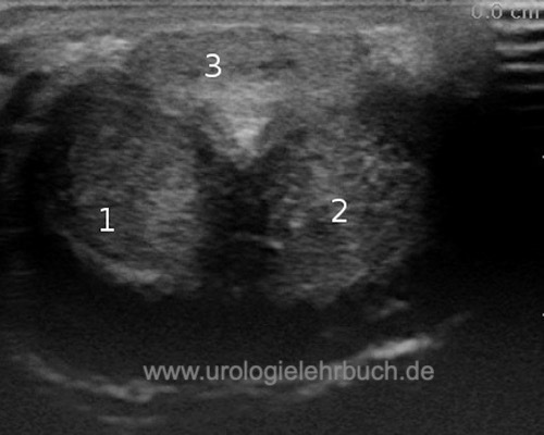 Abbildung Sonographie des Penis (Querschnitt von ventral) mit Corpus cavernosum und spongiosum