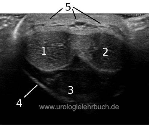 Abbildung Sonographie des Penis (Querschnitt von dorsal)