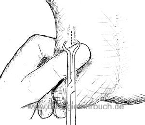 Abbildung Operative Technik der Vasektomie: erster Schritt