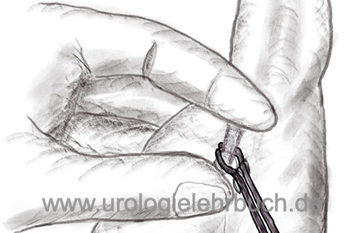 Abbildung Operative Technik der Vasektomie: Der Samenleiter wird im Skrotum mit Hilfe einer Ringklemme fixiert.