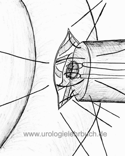 Abbildung: operative Technik der Vasoepididymostomie