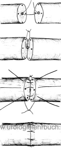 Abbildung: operative Technik der Vasovasostomie